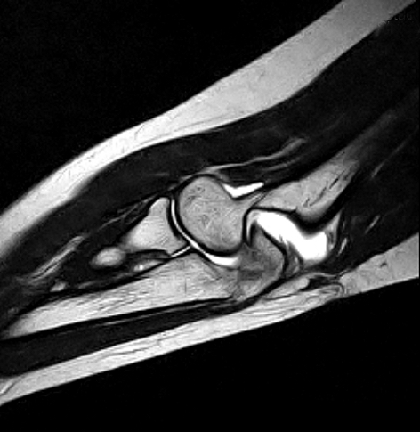 Elbow Sagittal MRI Scan